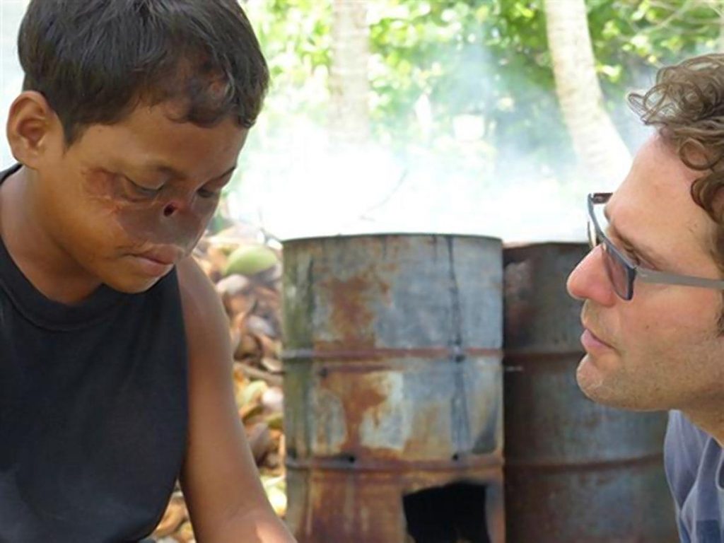 Dallan Jennet, from the Marshall Islands, fell on a live power line when he was 9 and his nose was essentially non-existent after getting badly burned. (OBTAINED BY NY DAILY NEWS/FOR NEW YORK DAILY NEWS)