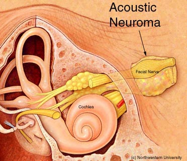 acoustic-neuroma
