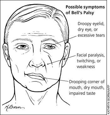 bells-palsy