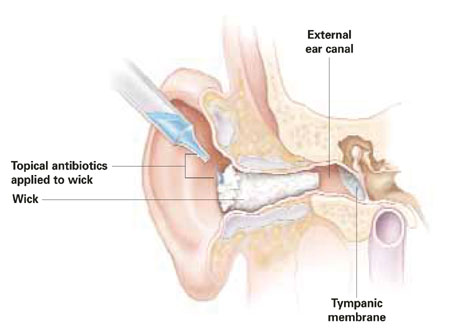 ear-wick
