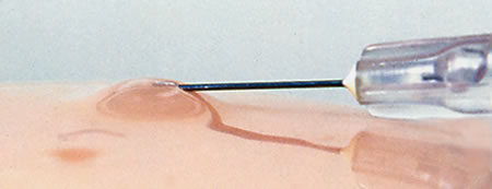 intradermal-injection