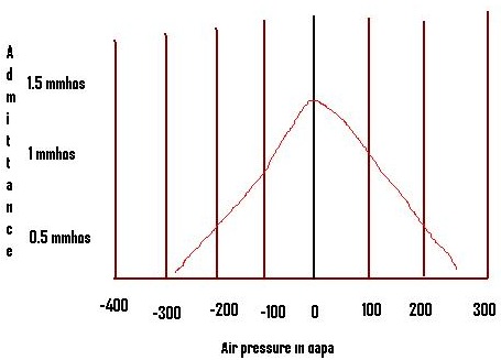 normal-tympanogram