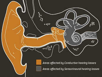 hearing-loss