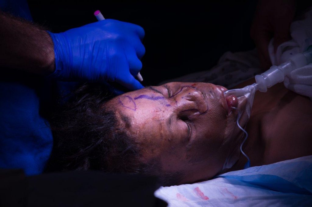 The metal plate infected his nose, though, and a new surgery was needed.